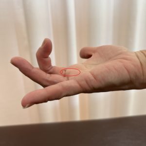 ばね指（指の腱鞘炎）